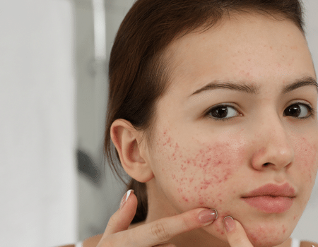 acne scars treatment in Qatar