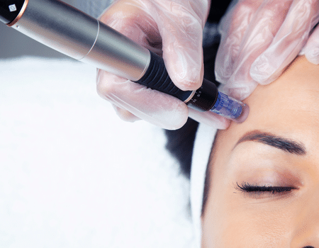 Mesotherapy for hair