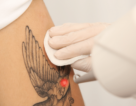 laser tatto removal in Qatar